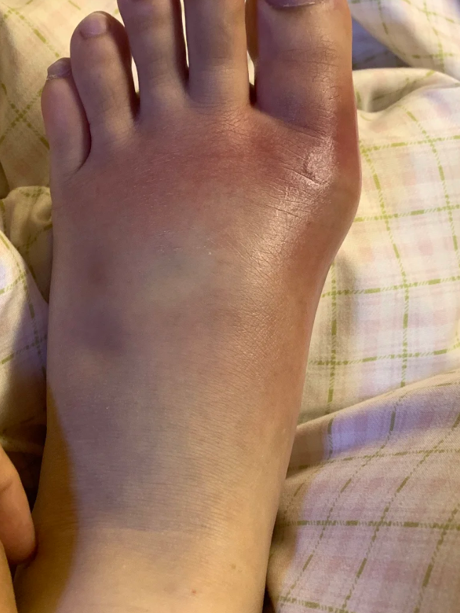 女性痛风的症状有哪些?