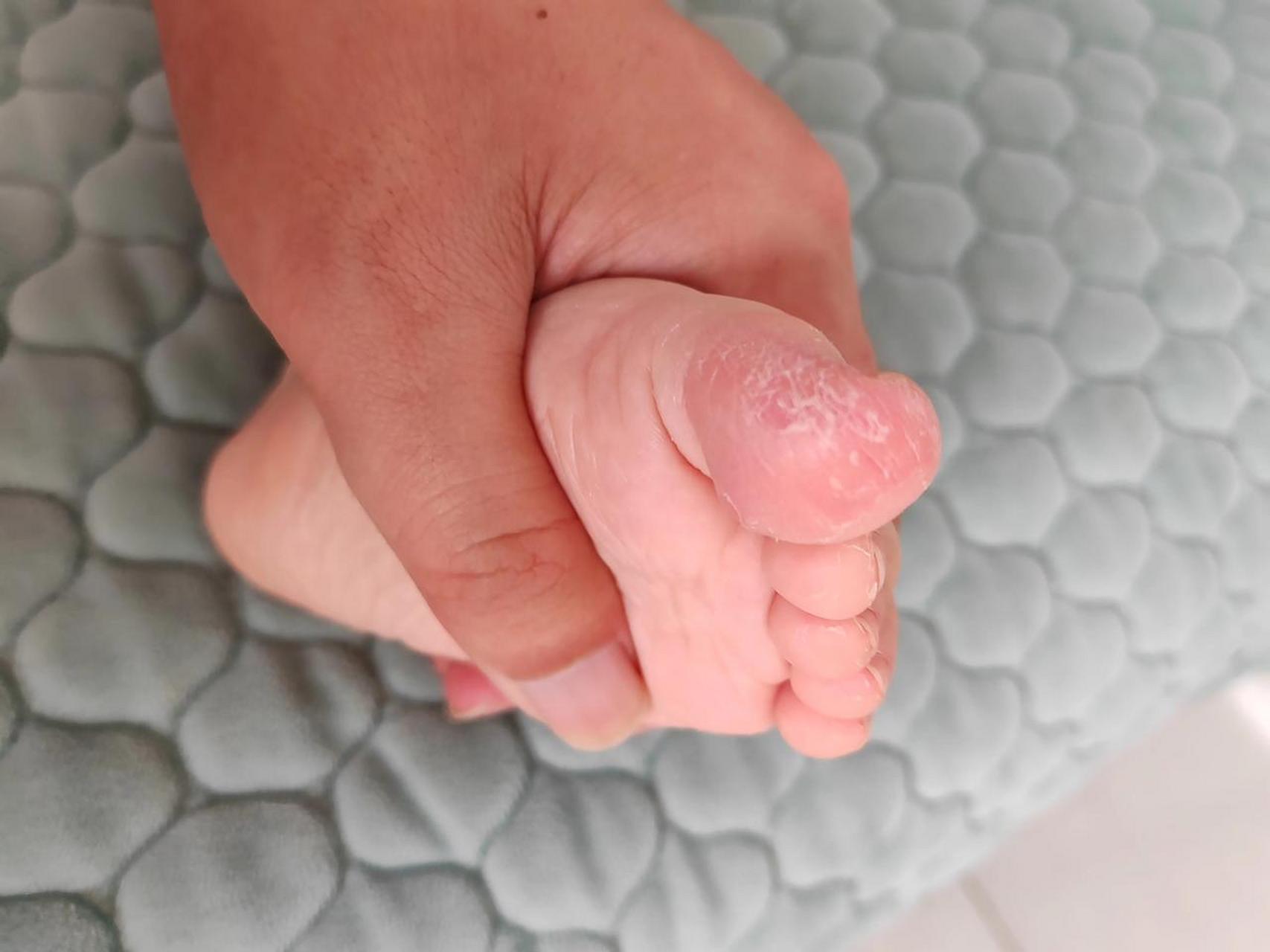 一岁半的宝宝脚趾头为什么一直脱皮呢?关键不疼不痒
