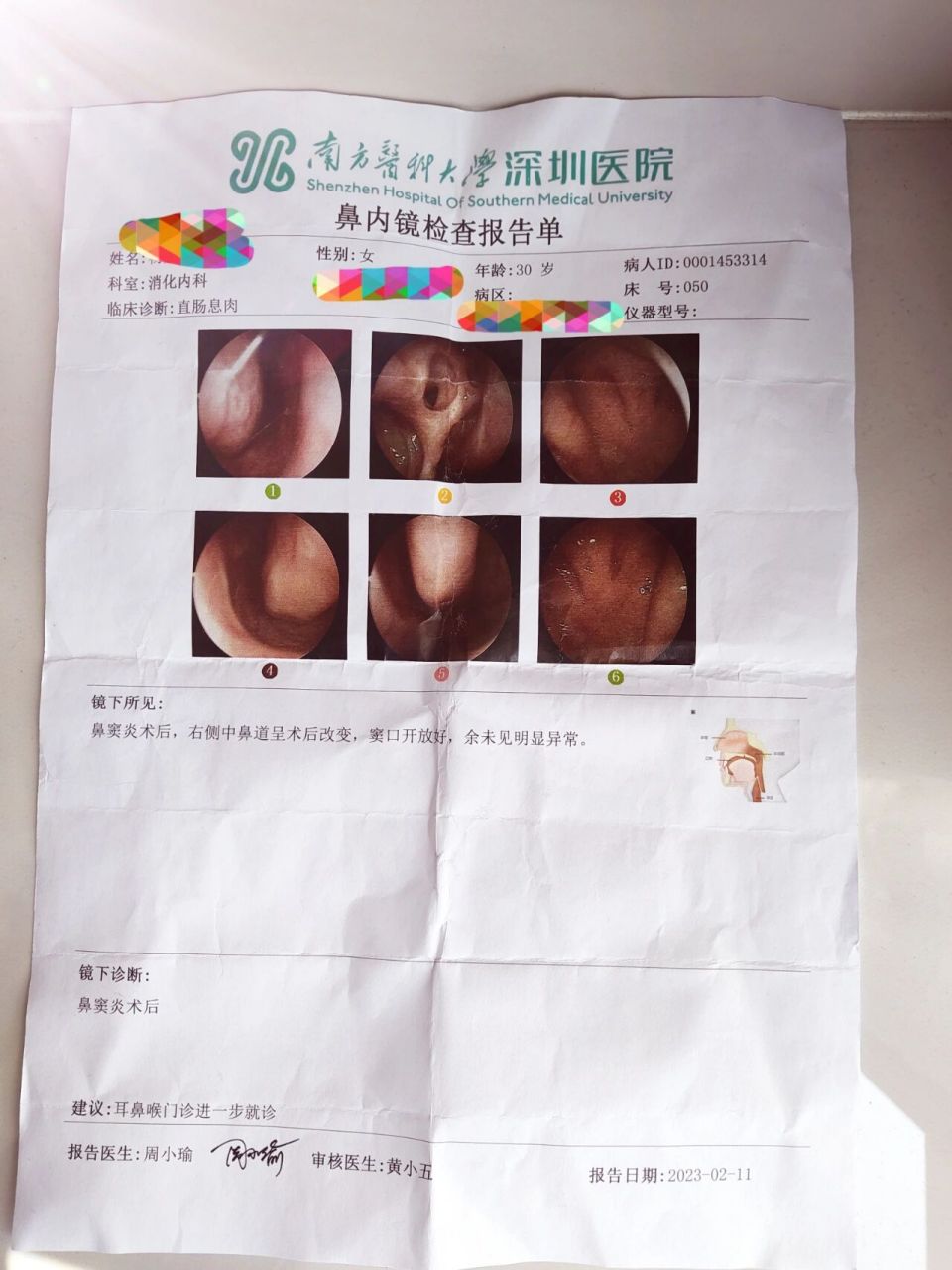 鼻窦炎开放鼻息肉手术后复查 鼻窦炎开放鼻息肉手术第十个月复查,前鼻