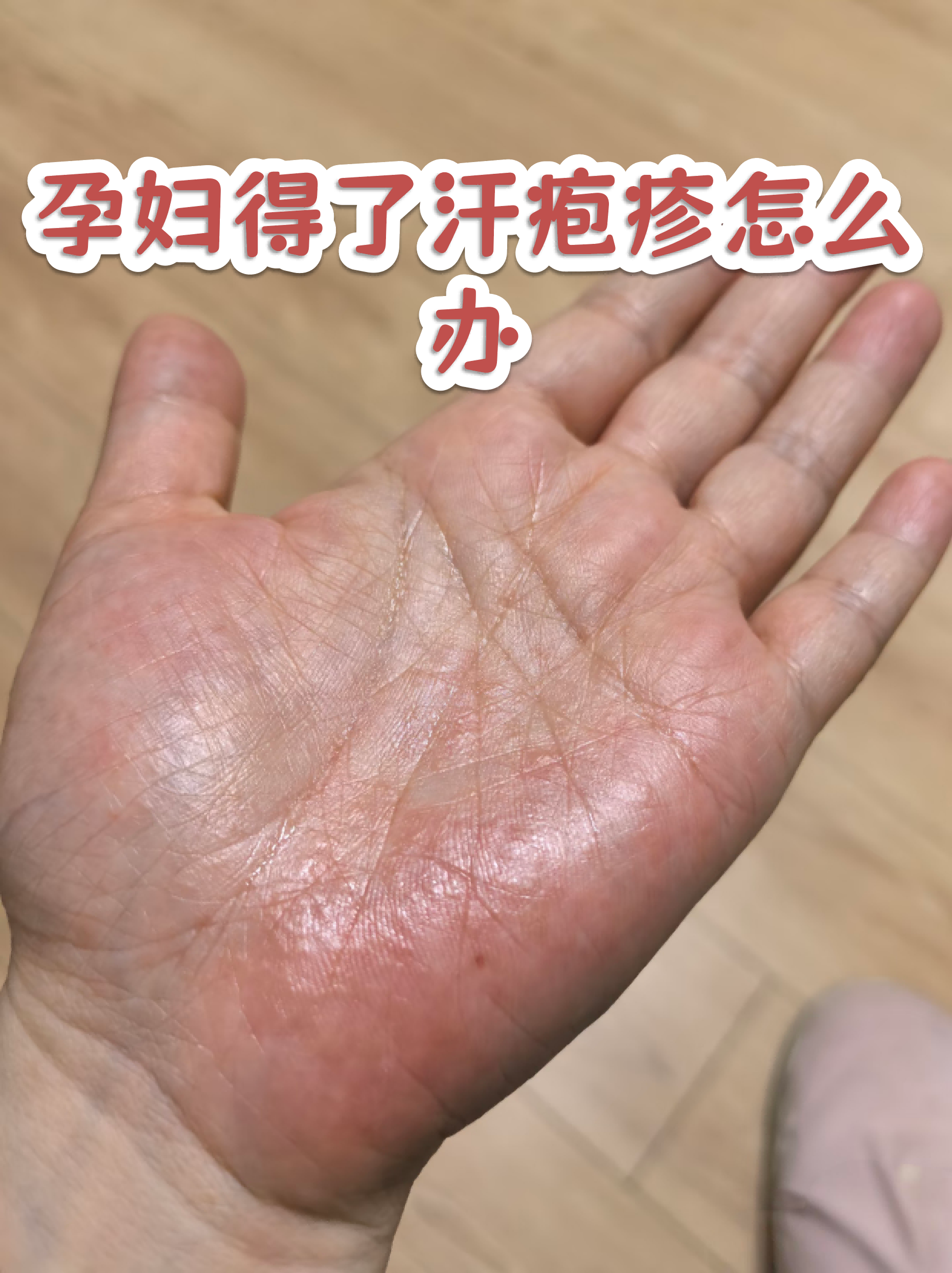 孕妇得了汗疱疹怎么办