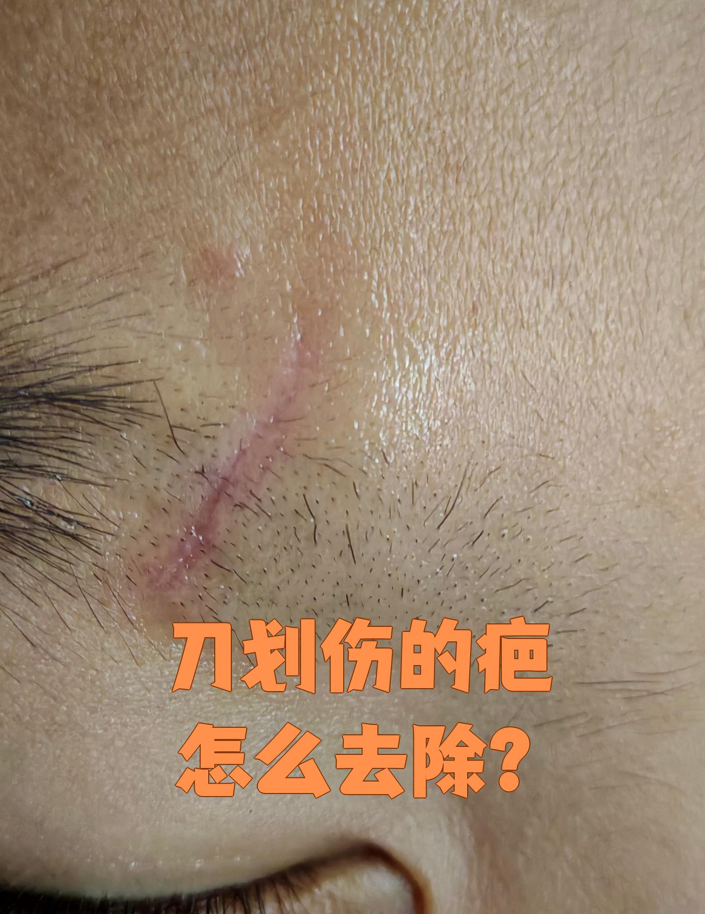 刀划伤后留下的疤痕,主要是由于真皮层受损,瘢痕体质或伤口护理不当