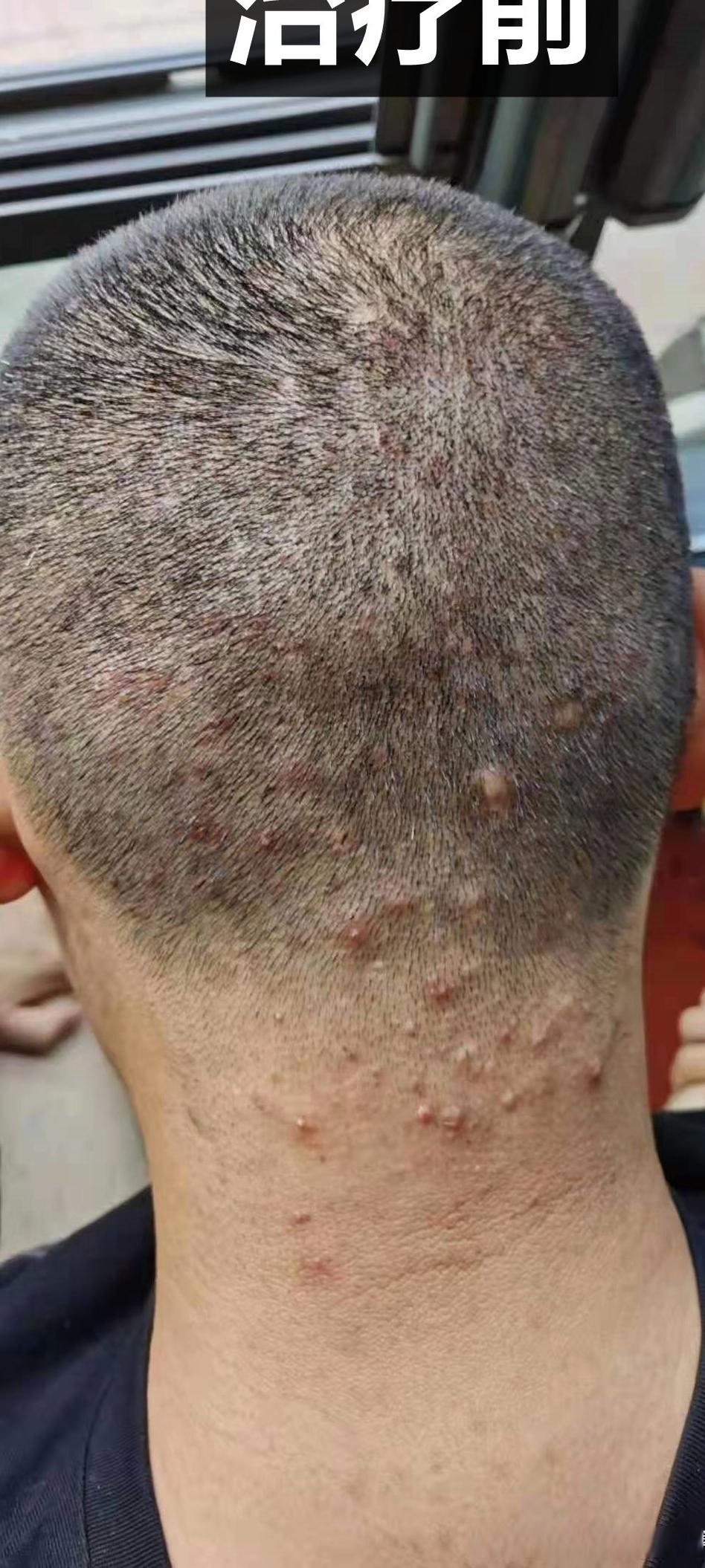 今天来复诊的这位患者,男26岁,毛囊炎3年,最初满头的小红疙,一碰到就