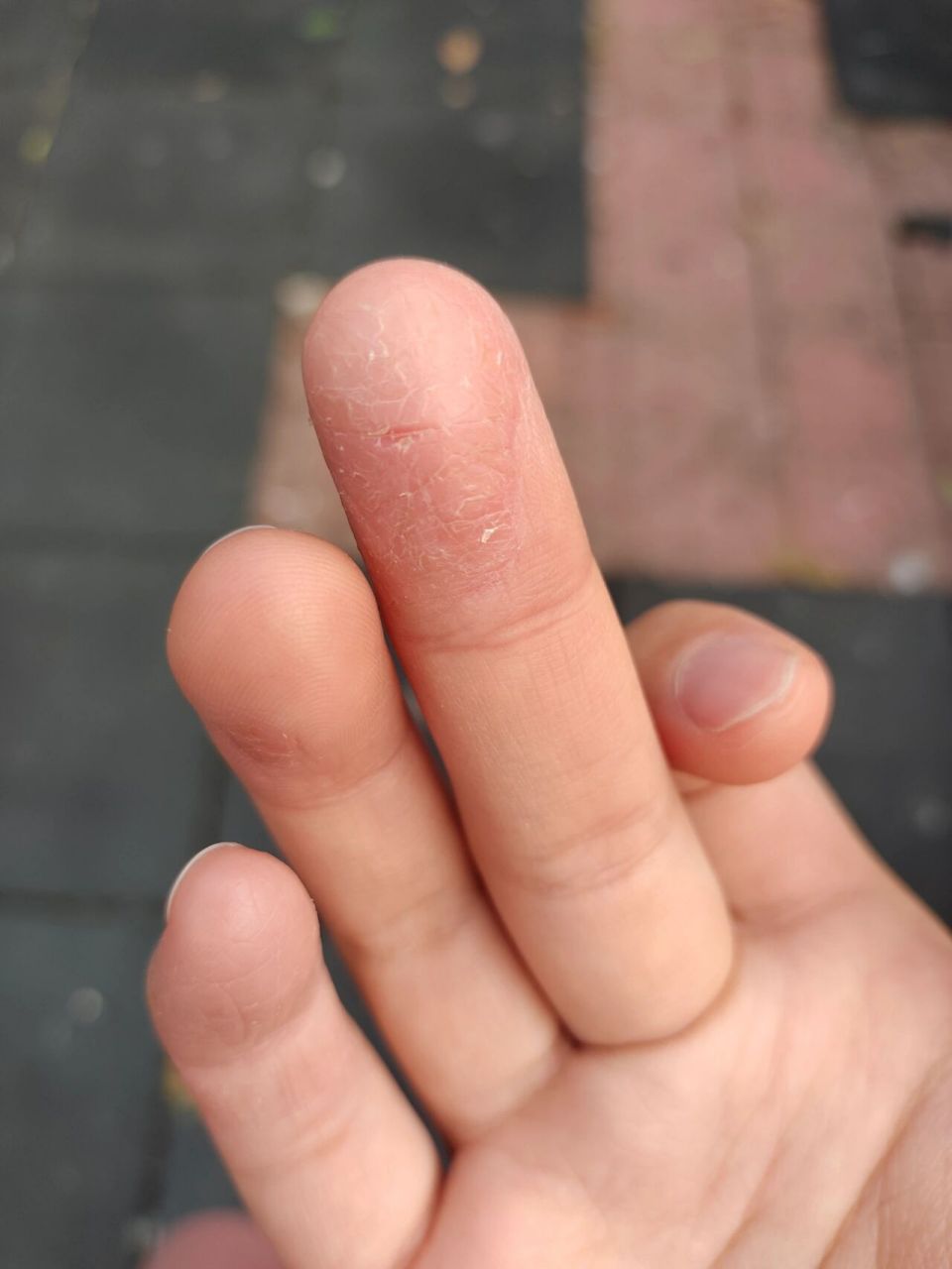 手指开裂啥原因啊? 有没有姐妹也这样啊?