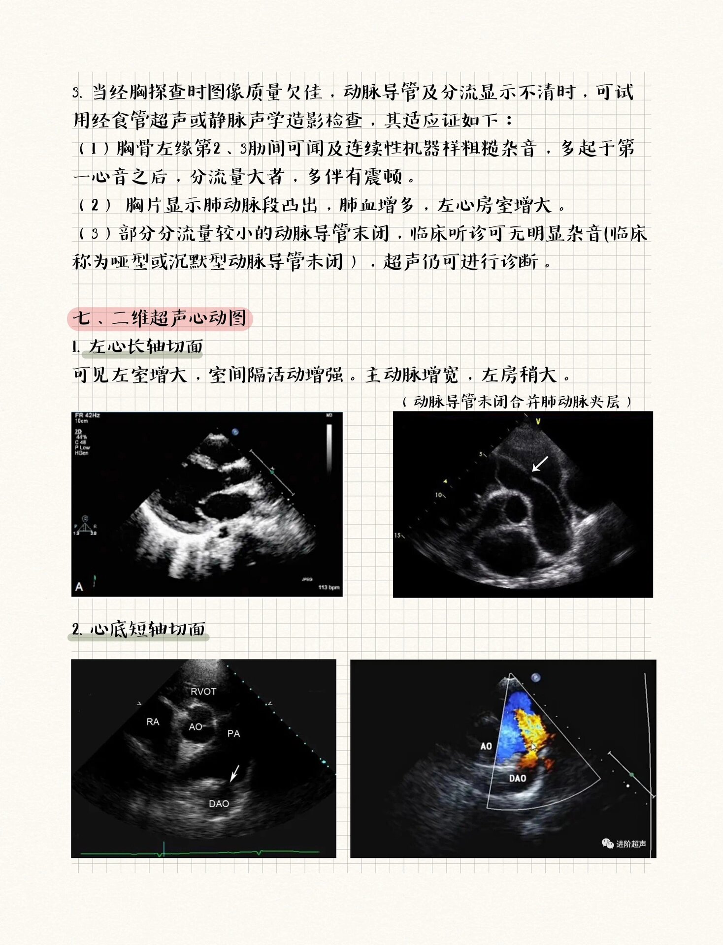 动脉导管未闭彩超图片