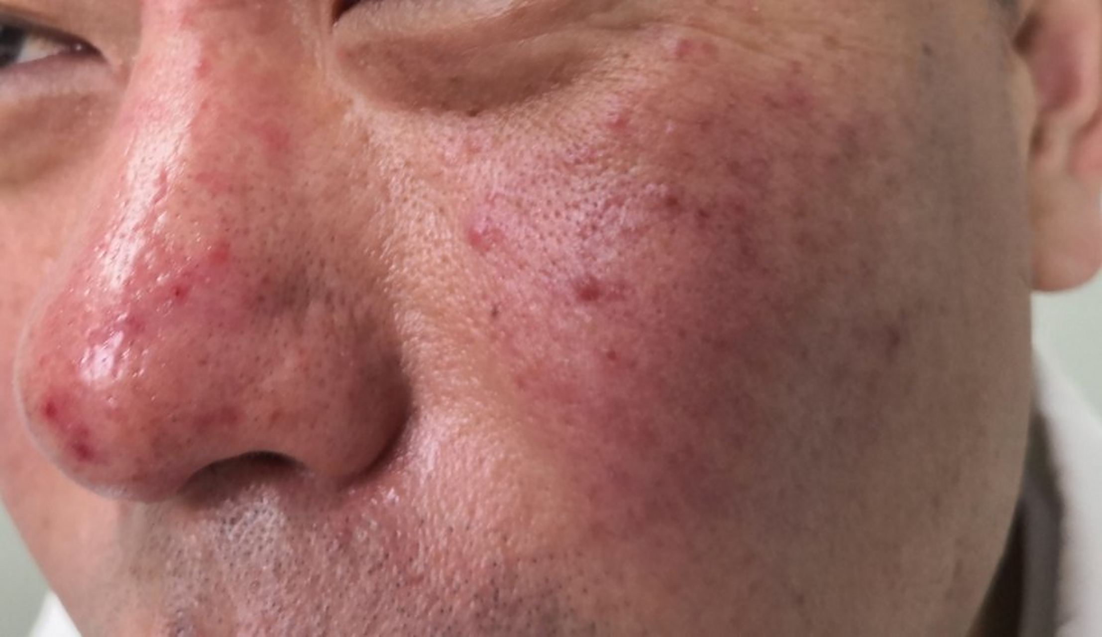 面部玫瑰痤疮症状.面部潮红,炎性丘疹,结节.