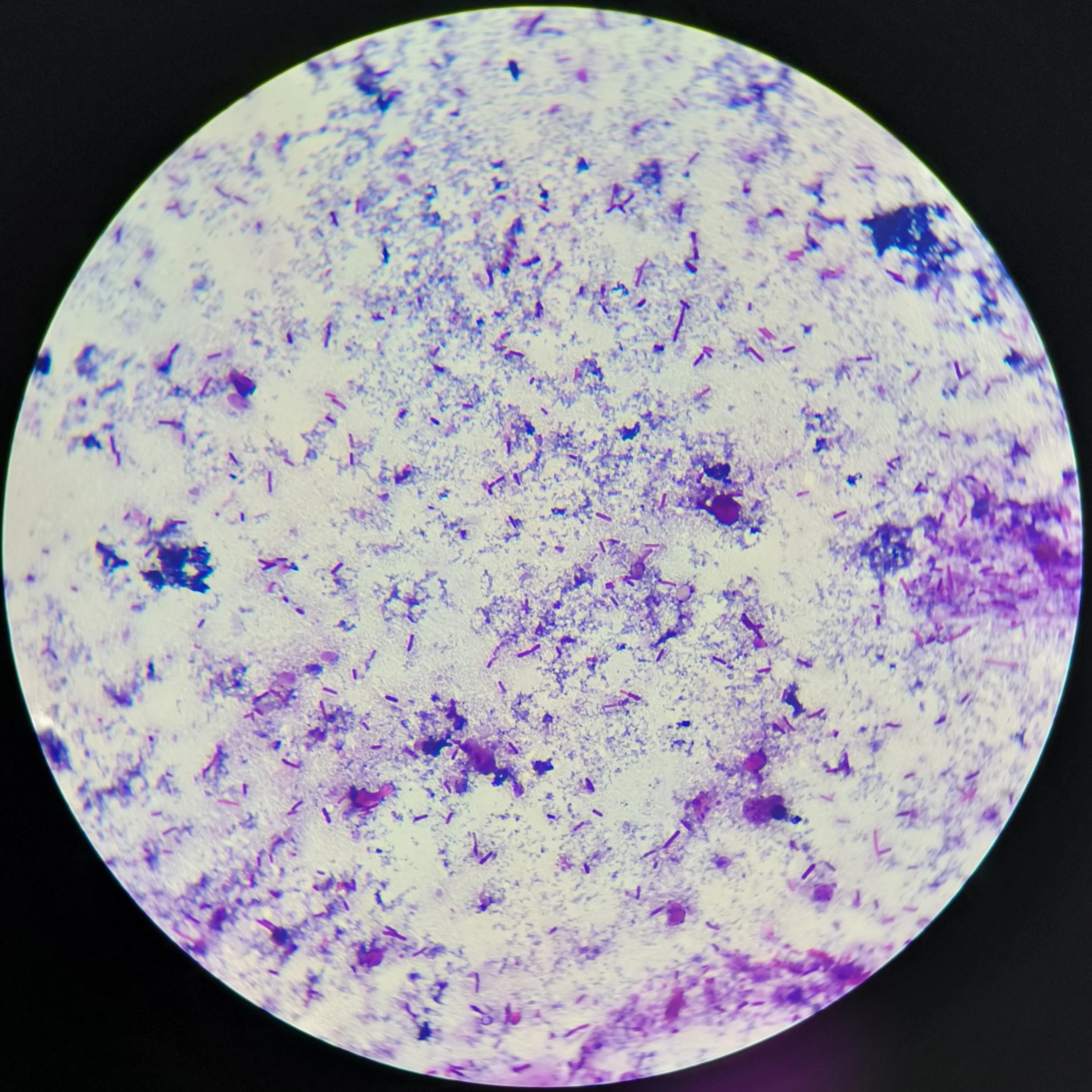 镜检为革兰氏染色.可以看到,阴性菌异常增殖,菌群比例失调.