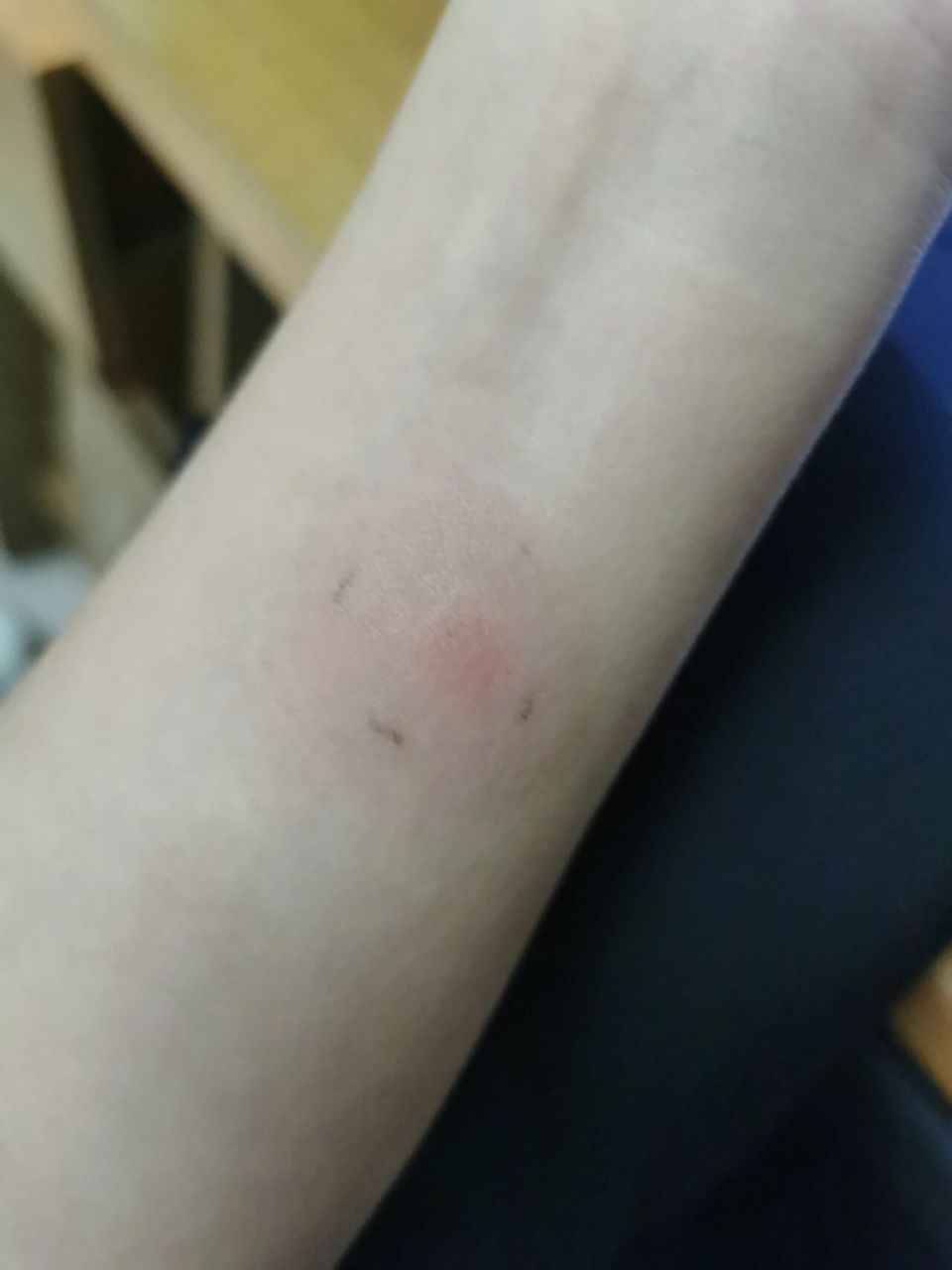 ppd皮试第四天(72小时)1.9*1.9 本科体检的时候也是这样的情况,当时是