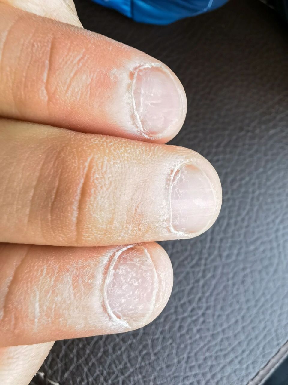 七岁半男孩手指甲盖坑坑洼洼的 之前给儿子剪指甲的时候就发现指甲盖