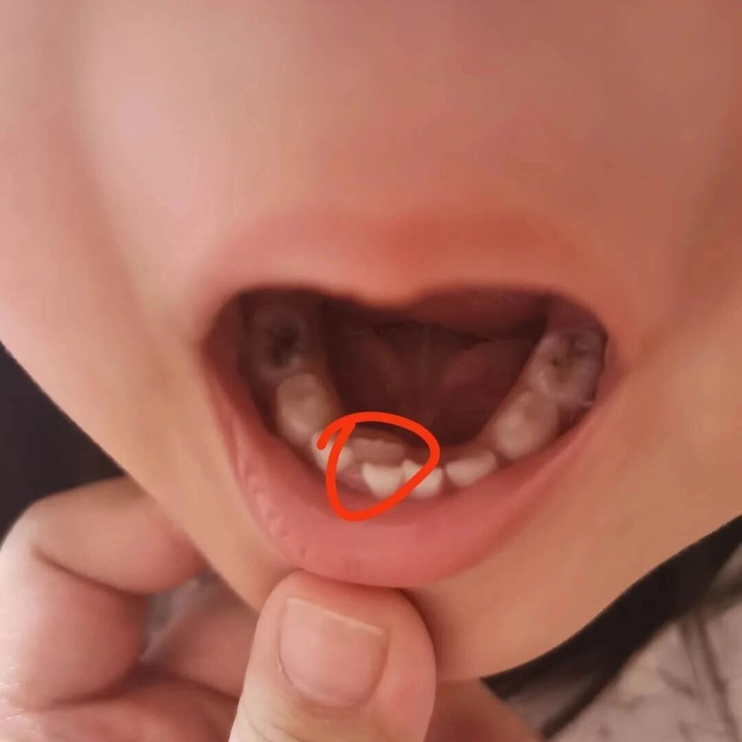 拔了双层牙以后牙齿就长歪了?