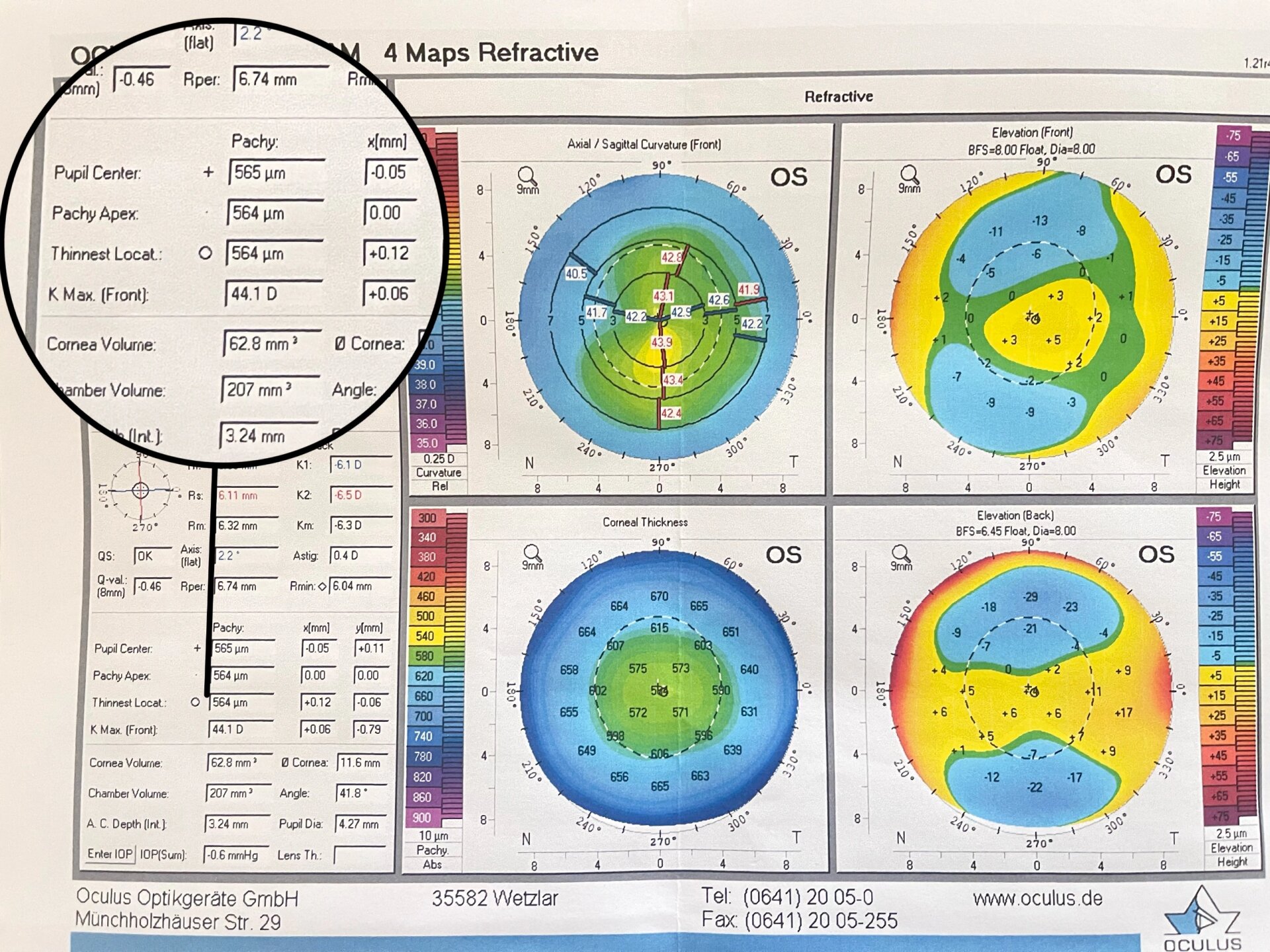 角膜厚度你们是多少呢?