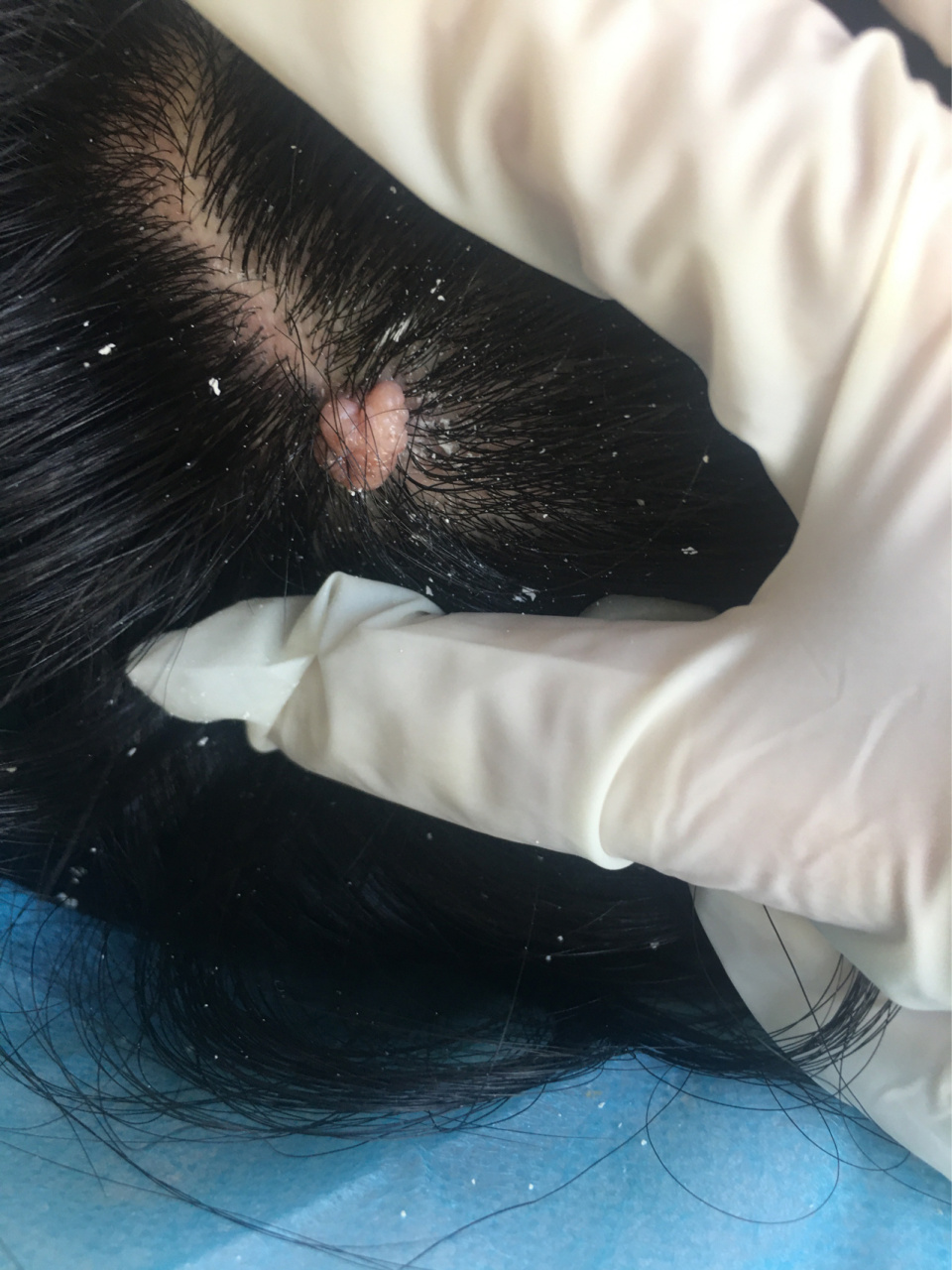 菜花疣 头皮部的疣,最早从外观上看可能就是皮赘样的小突起,但由于