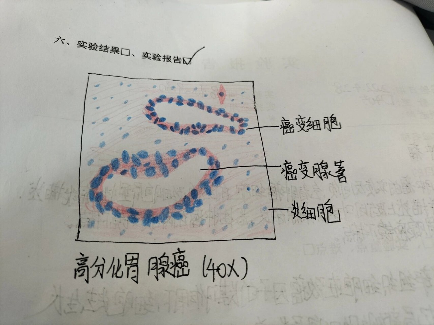 病理切片之高分化胃腺癌 癌变细胞呈异型性,形态大小不一,层次多,染色