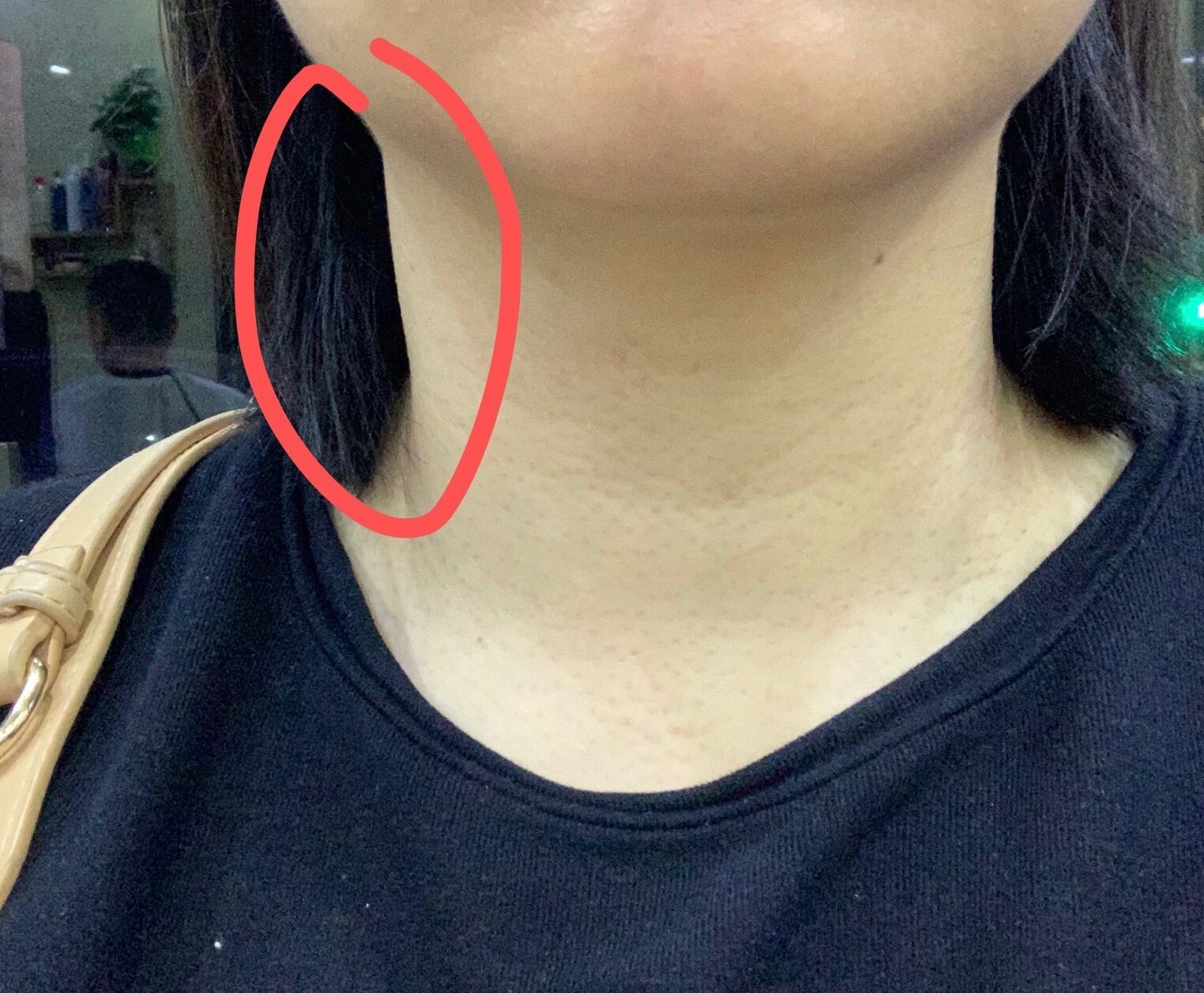 脖子淋巴结肿大