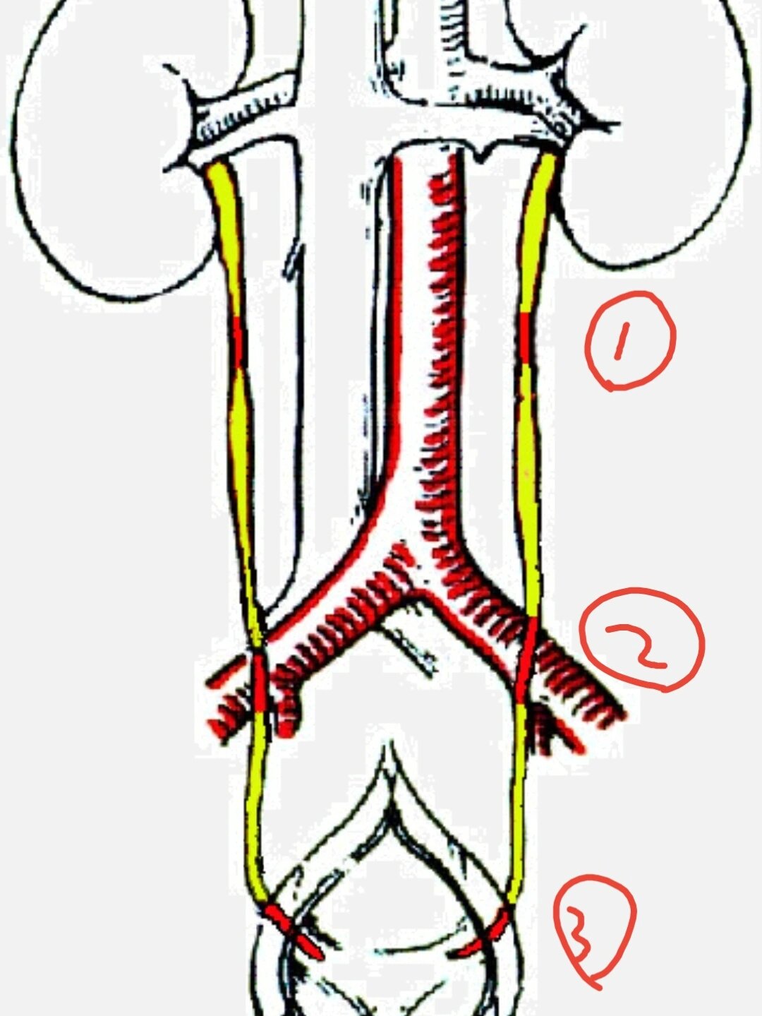 25岁肾结石8天排石7515(后续来啦95) 25岁肾结石 不要太痛苦惹