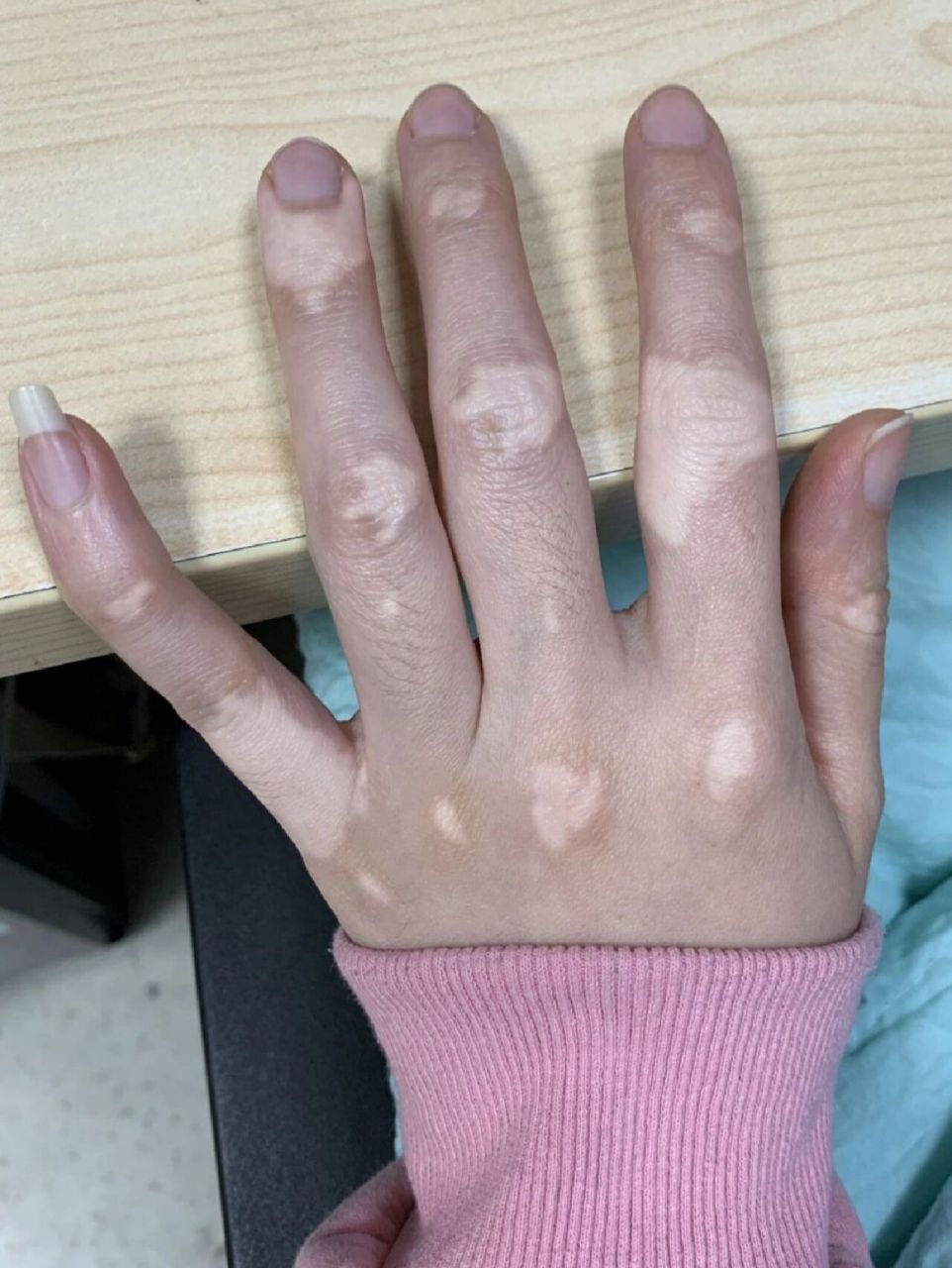 白癜风简介 白癜风是一种难治性皮肤病,一般为局部或泛发性色素脱失