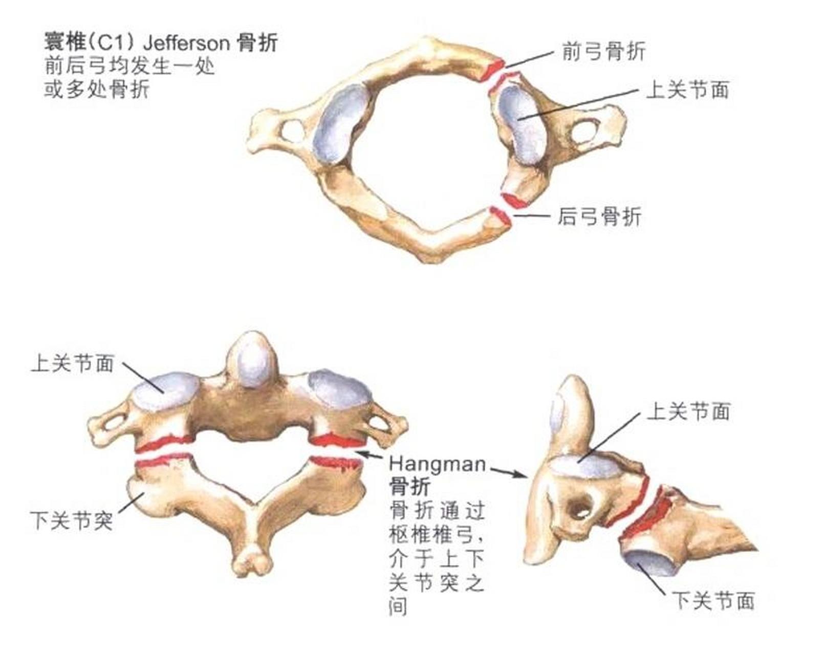 寰椎前后弓骨折图片