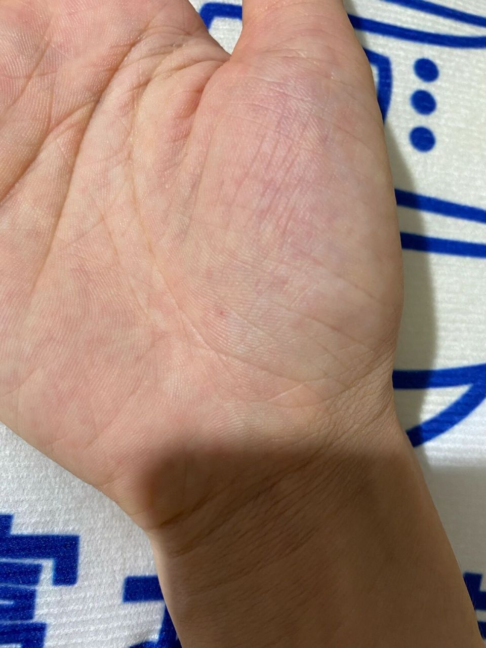 手掌心长了红点 你们知道这是什么吗?