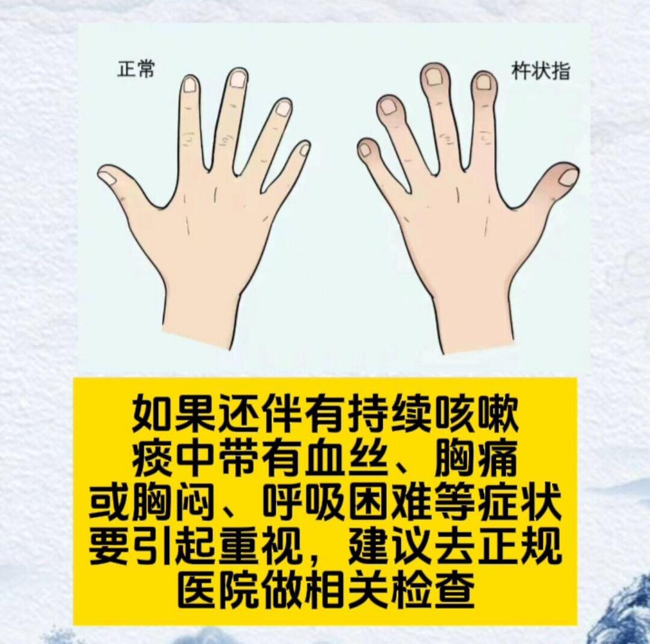 杵状指是肺癌的典型症状,快看看你的手!