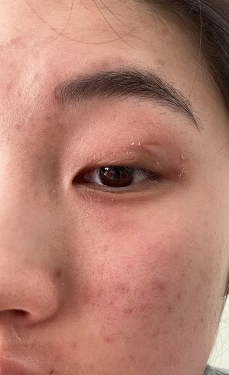 眼睑上唇过敏药物治疗后逐渐好转中#过敏##接触性皮炎