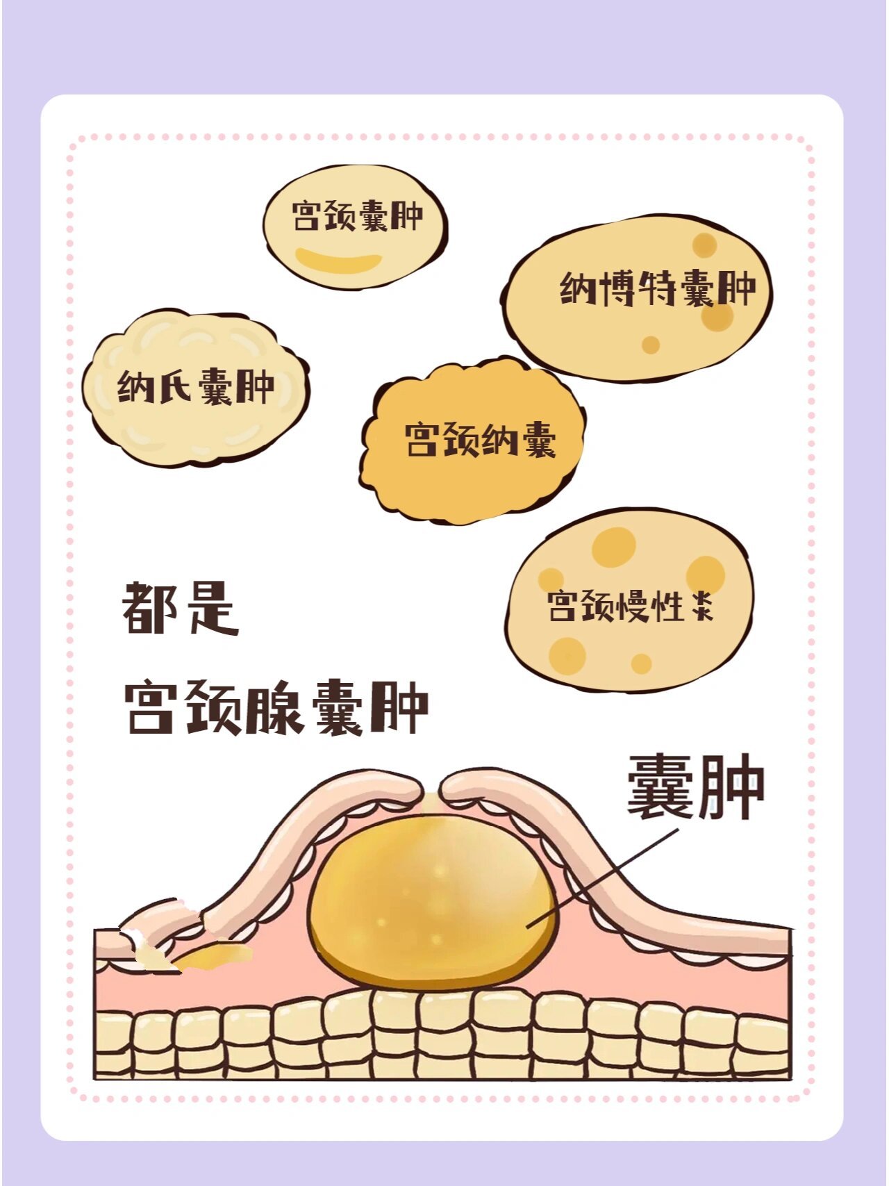 之前"甜甜圈一样的宫颈"引起了热议,也有一些姐妹表示自己有宫颈纳 
