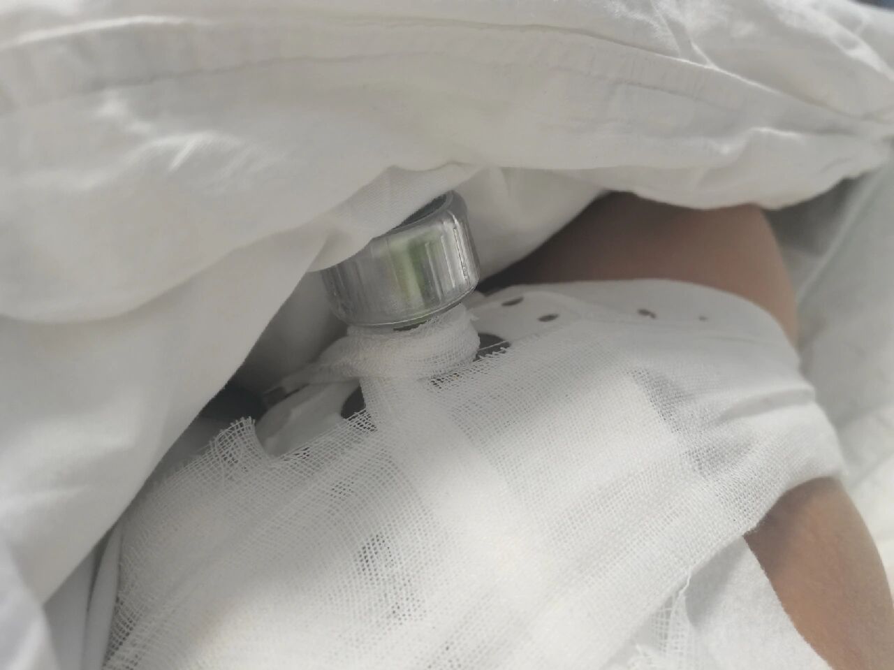 心脏射频消融