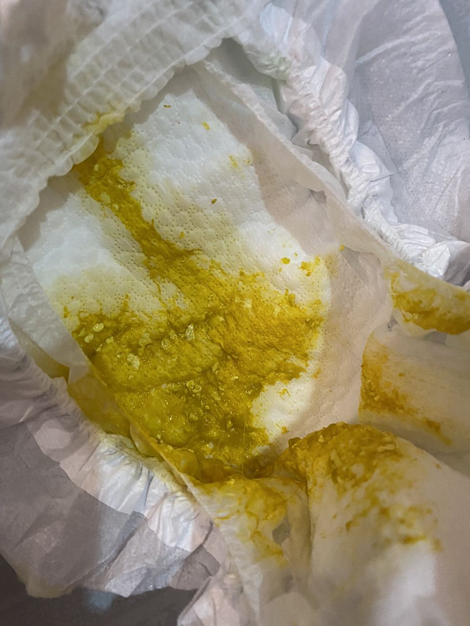 宝宝的粑粑有奶瓣和粘液 之前宝宝有点拉肚子,医生开了双歧杆菌三联活