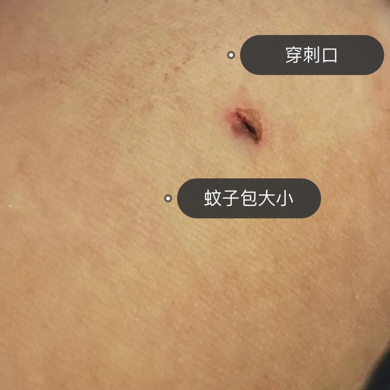 射频消融手术|住院及手术经历分享(下) ⚠️图4⃣️为伤口图