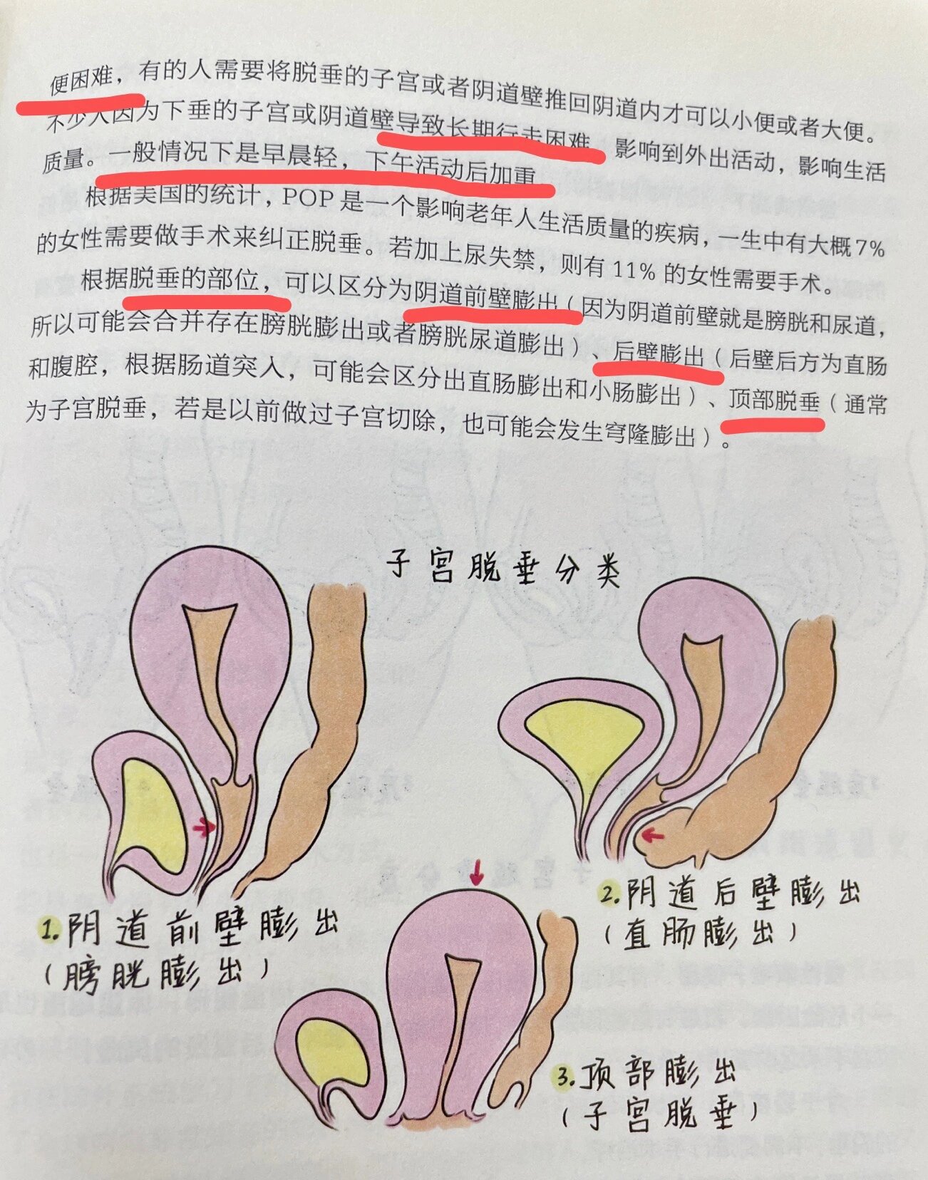 直肠膨出图片图片