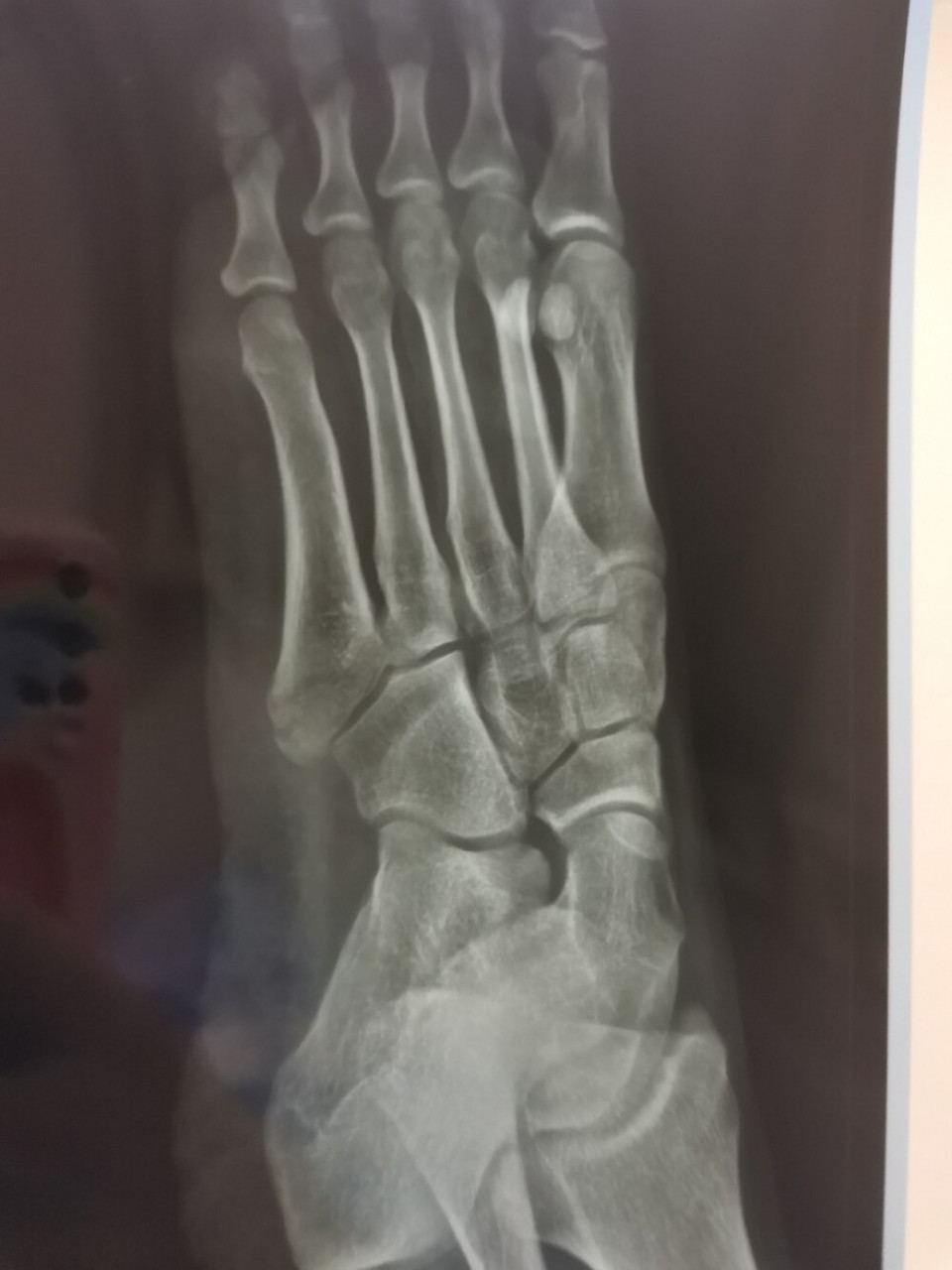 22的片子,感觉快一个月了骨折线还是一模一样一点没愈合.