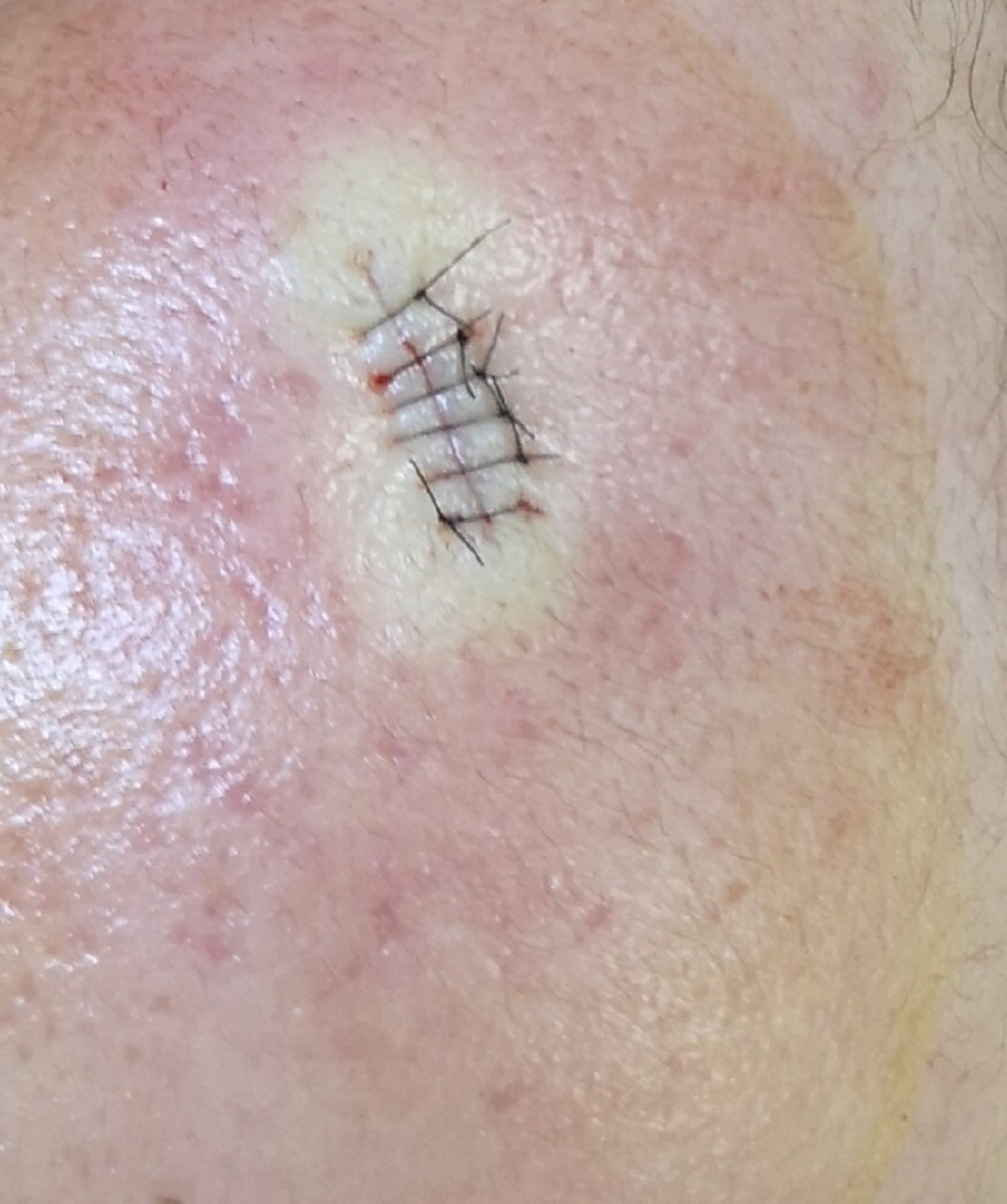 色素痣的切除 有很多朋友问我要点痣,有的比较小的可以激光点掉,有