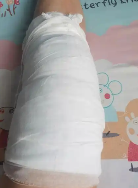 根据骨折的严重程度,可能要做石膏固定或者手术