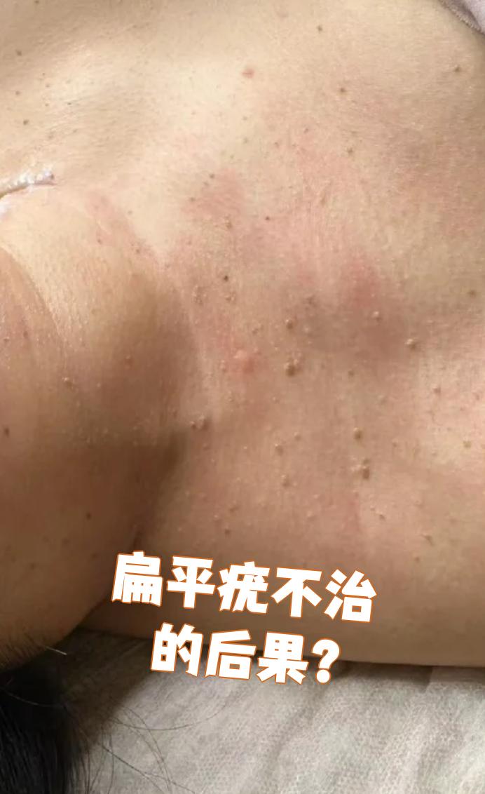 扁平疣如果不治疗,可能会带来三个主要问题:传染,瘙痒和影响美观