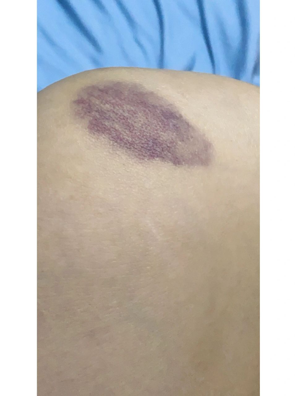 为什么膝盖那么容易淤青 轻轻撞一下就这样