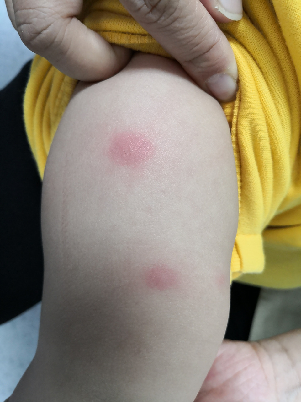 儿童丘疹性荨麻疹症状#过敏##解决皮肤问题专注皮肤美容##虫咬皮炎