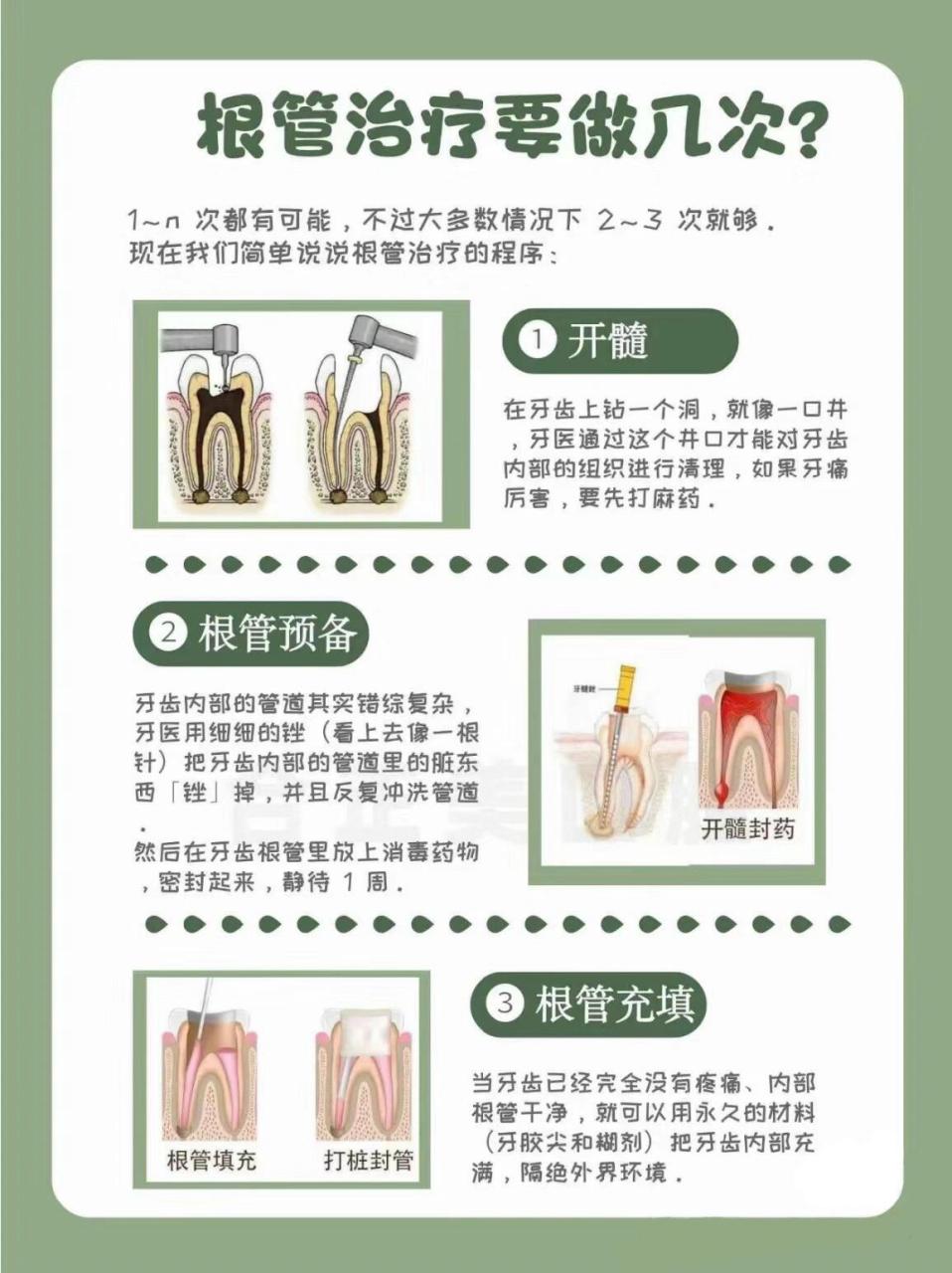 牙齿根管治疗图片步骤图片