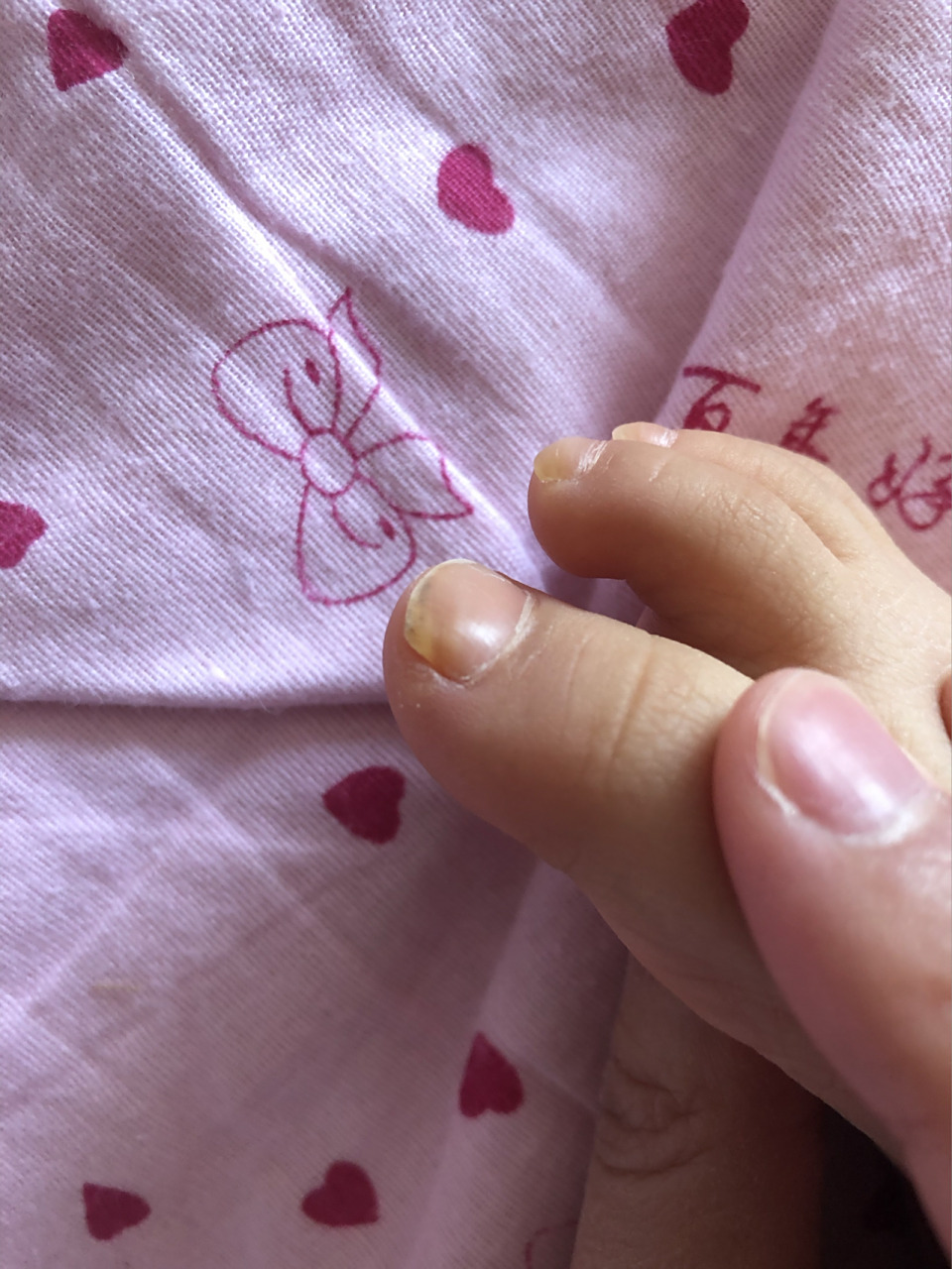 原来是甲(指甲)营养不良 1岁半宝宝脚趾指甲黄且厚,医生说是甲营养