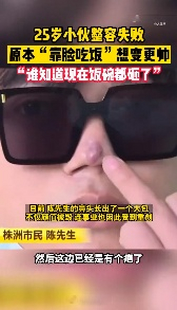 【#25岁小伙做鼻子整形失败毁容#】"我本来是靠颜值吃饭的,现在没法