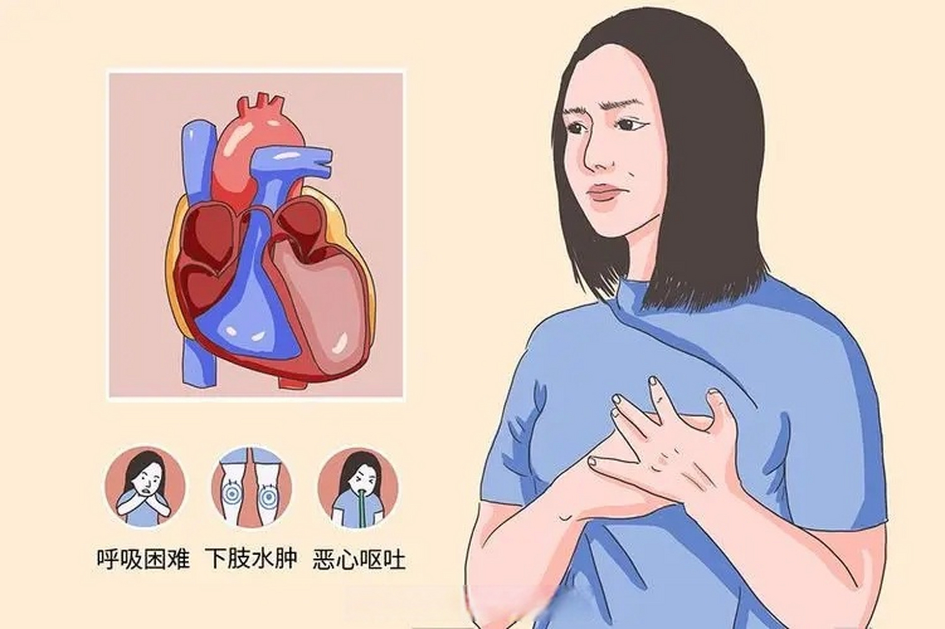 心力衰竭通常是由于心脏疾病导致心脏功能受损引起的,可以出现气促