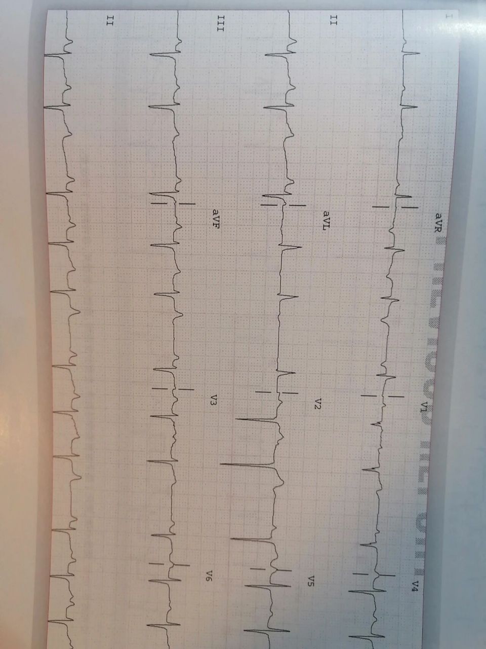 一度房室传导阻滞:p-r间期>0.12s,通常临床无症状. 2.