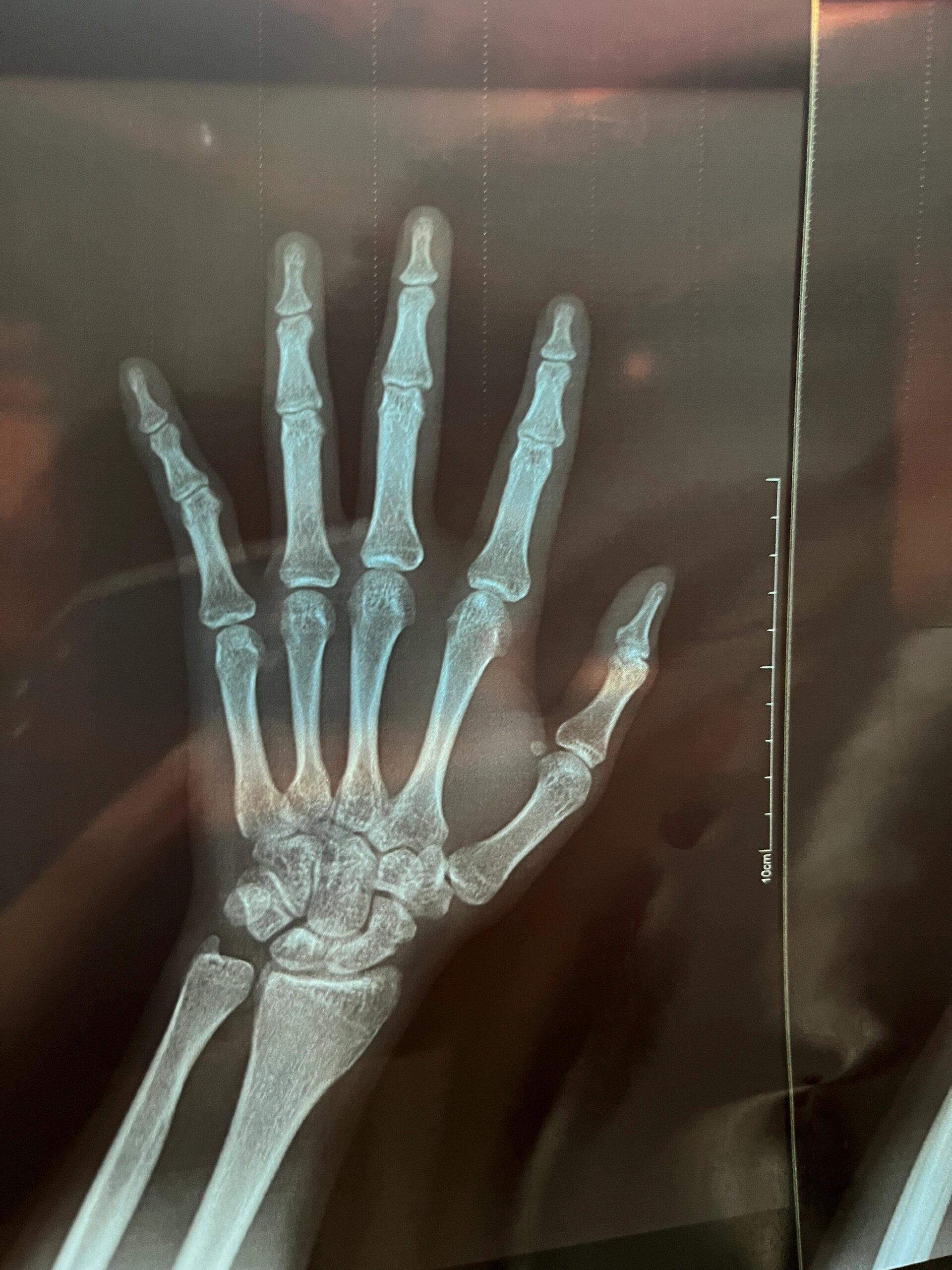 图片手腕舟骨骨折图片手腕骨折舟状骨骨折腕舟状骨骨折舟骨骨折x片