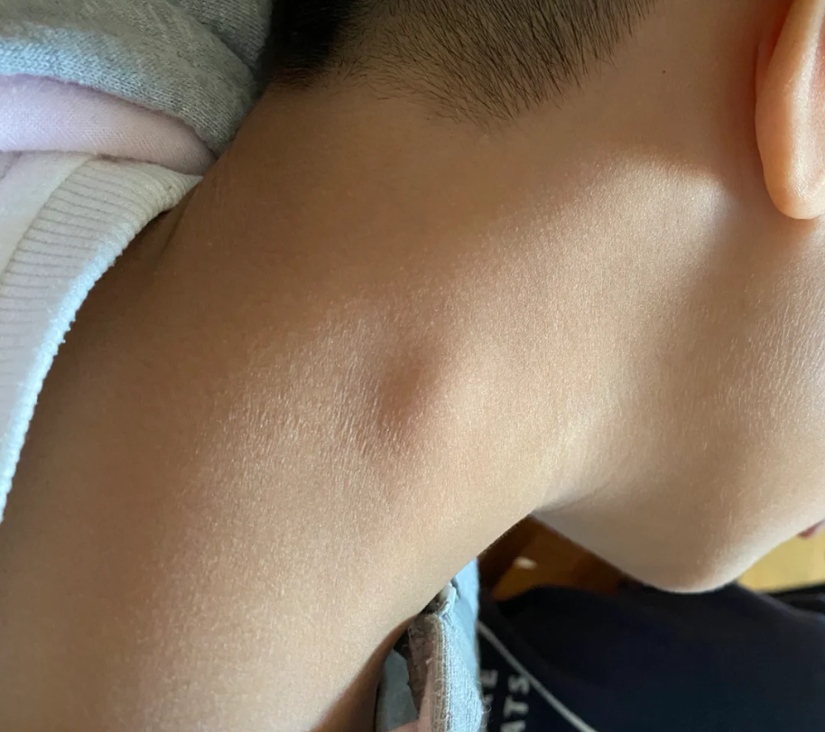 脖子上淋巴结的治疗需要先做详细检查才能确定方案