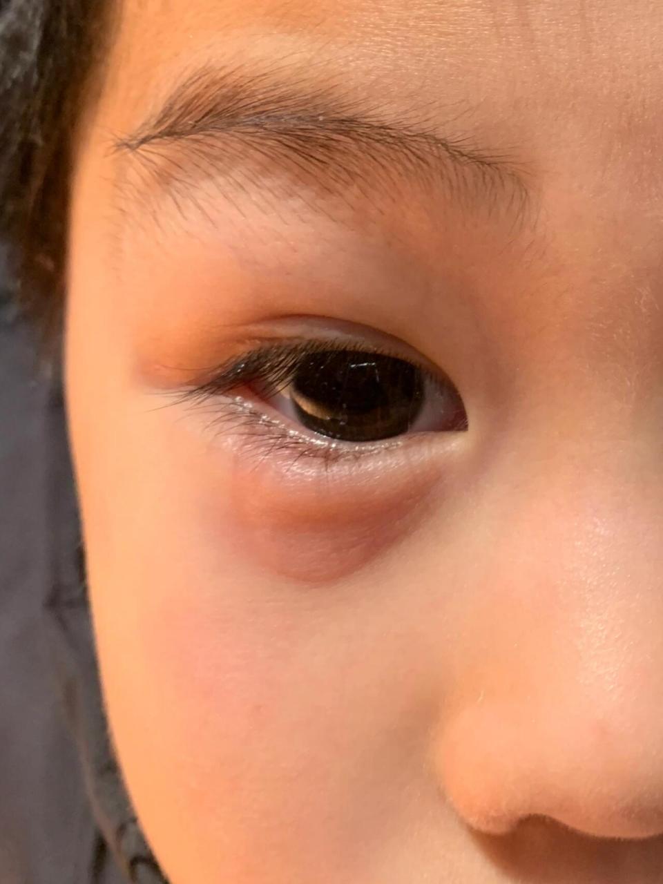 10分钟之后肿了 小朋友白天没事,晚上准备吃饭,发现眼睛有点肿了,10