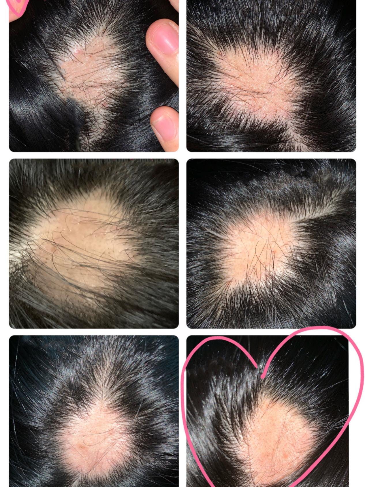 最近有点斑秃越来越大了怎么办斑秃能自愈吗