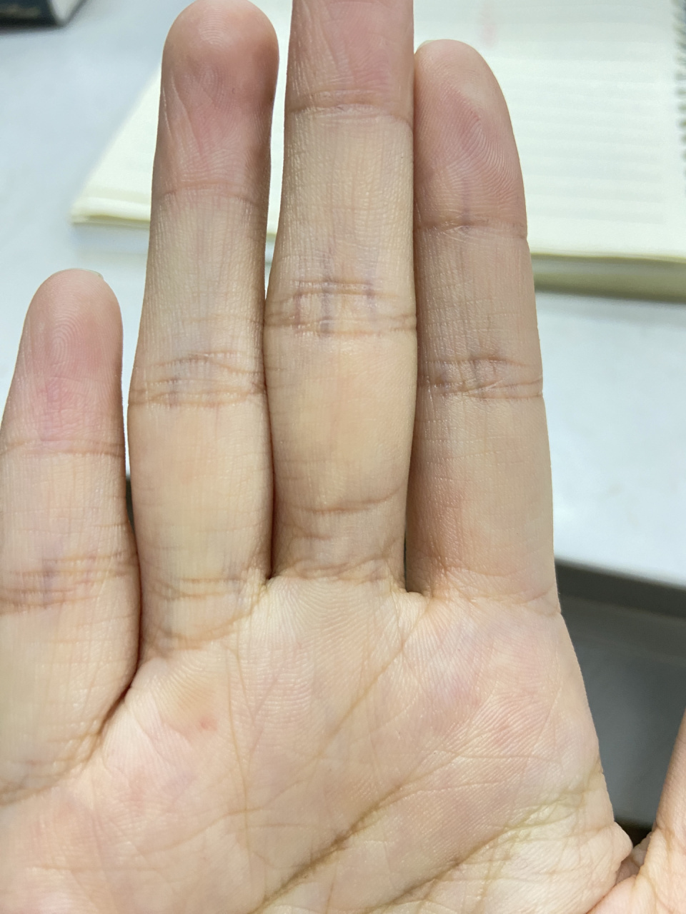 手上血管变紫,有知道什么原因的吗 最近两天突然发现手指上的血管明显