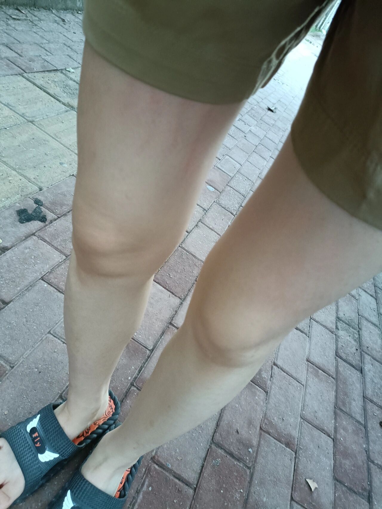 你们走路大腿会痒吗 我刚走了五分钟大腿开始发痒 痒的不行  这个是