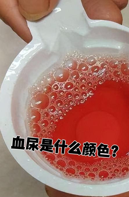 比如全程肉眼血尿通常说明出血来自上尿路