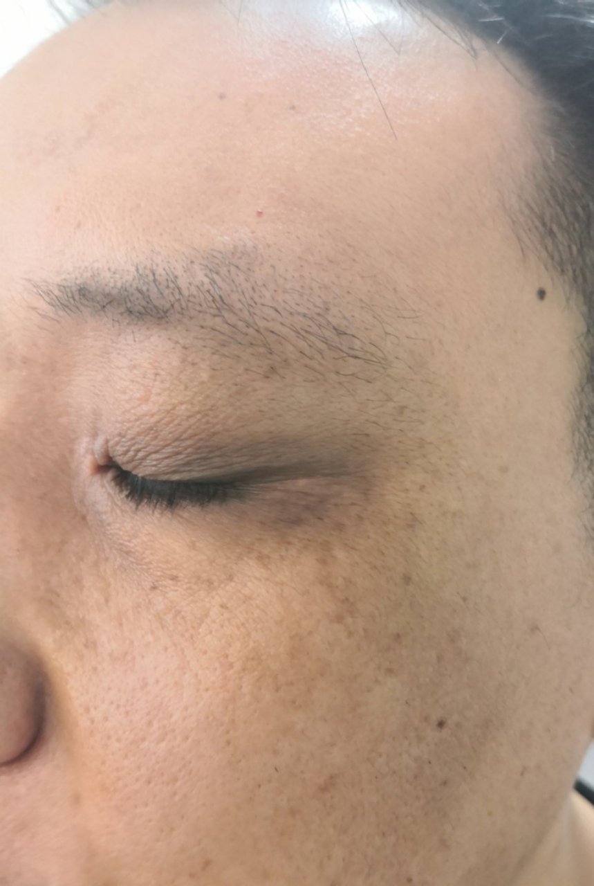 黑眼圈和面颊颧骨部位黄褐斑.