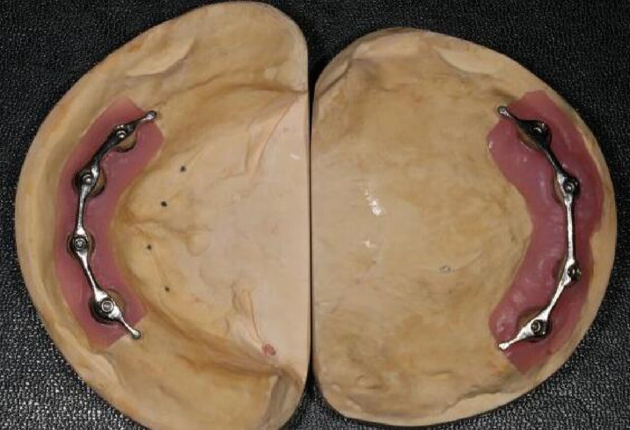 杆卡式种植覆盖义齿是个啥