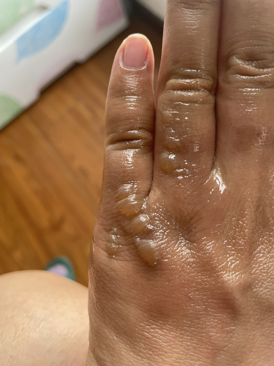 烫伤膏推荐 今天被蒸汽熏了半个手背,疼的要死,用了两种药,图片这个