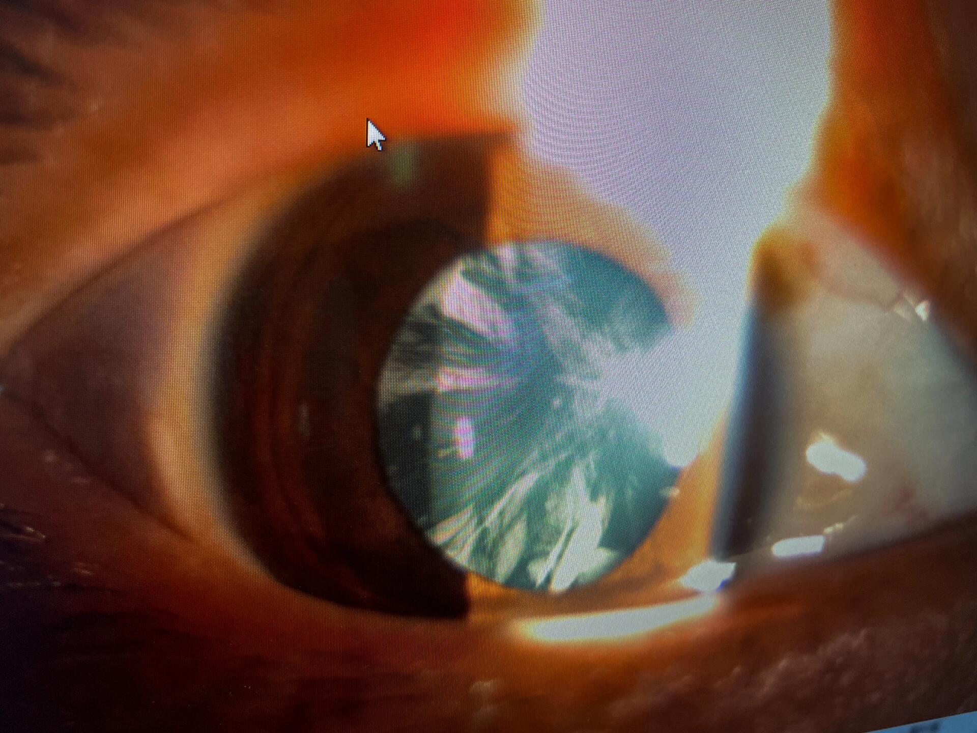 30岁左右白内障一例 照片分别为右眼和左眼的前节照相,可见晶状体较为